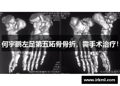 何宇鹏左足第五跖骨骨折，需手术治疗！